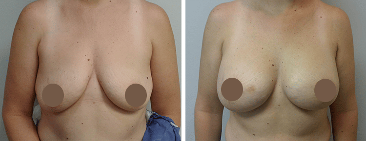 Breast Augmentation Patient 13