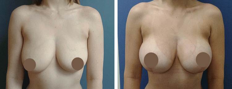 Breast Augmentation with Lift Patient 14