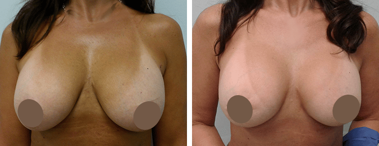 Breast Augmentation with Lift Patient 15