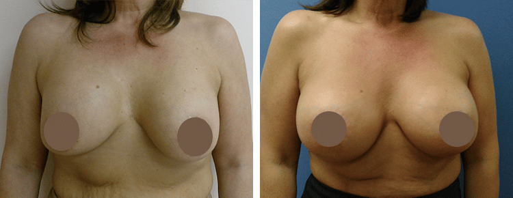 Breast Augmentation with Lift Patient 34