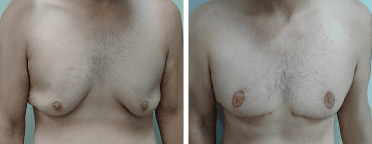 Breast Lift Patient 24