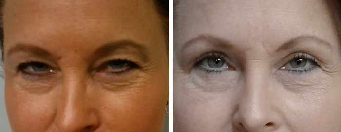 Eyelid Surgery Patient 27