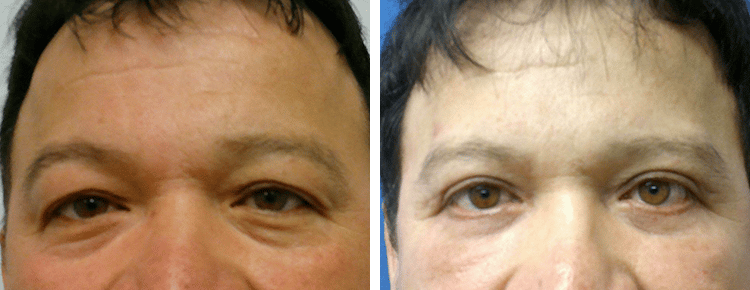 Eyelid Surgery Patient 29