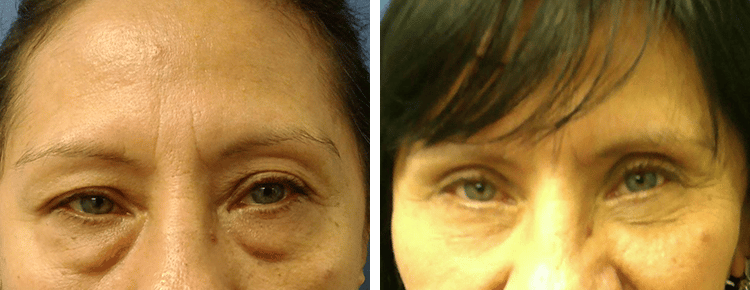 Eyelid Surgery Patient 28