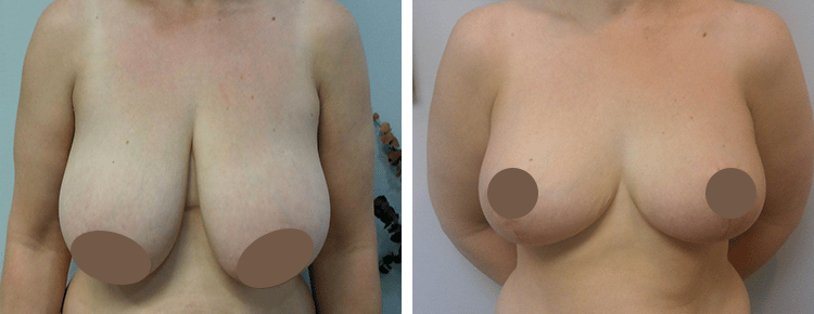 Breast Reduction Patient 38