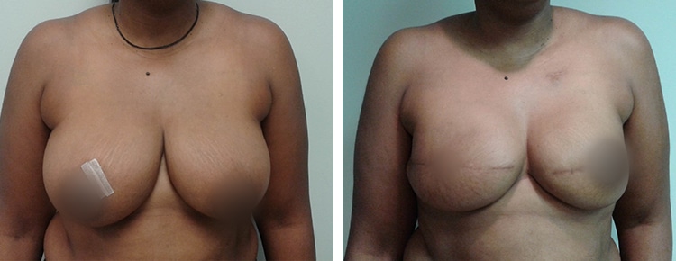 Breast Reconstruction Patient 44