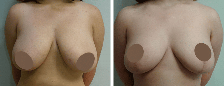 Breast Reduction Patient 42