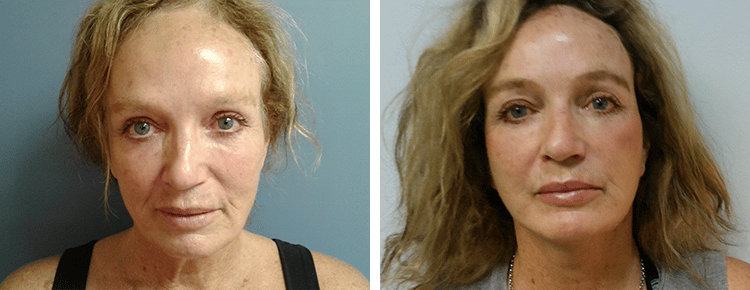 Face Lift Patient 40