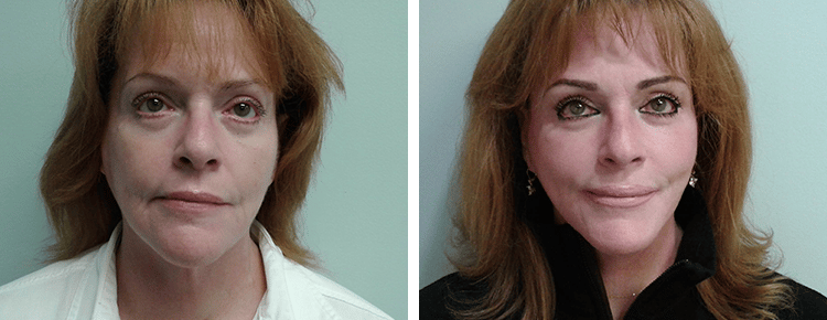 Face Lift Patient 41