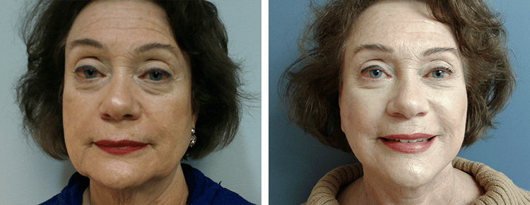 Face Lift Patient 46