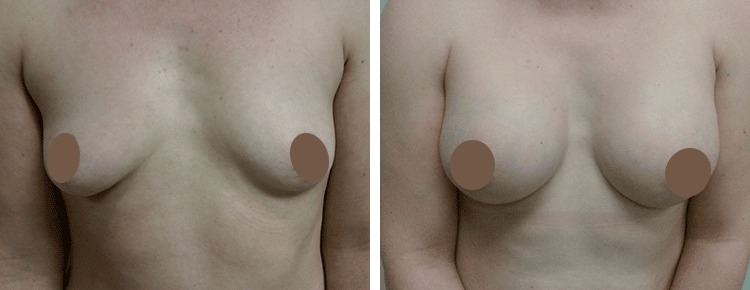 Saline Breast Augmentation Patient 1