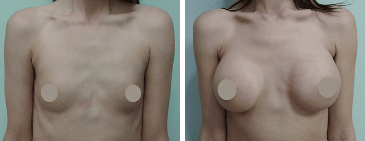 Saline Breast Augmentation Patient 18