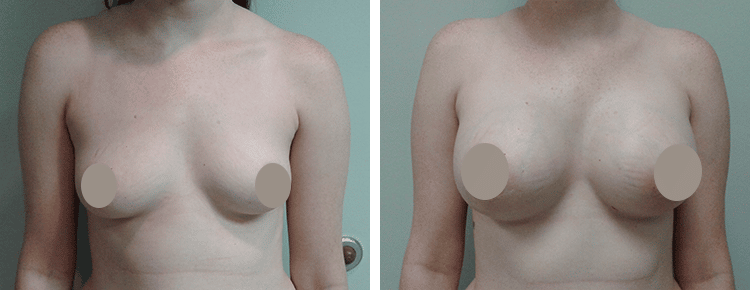 Saline Breast Augmentation Patient 19