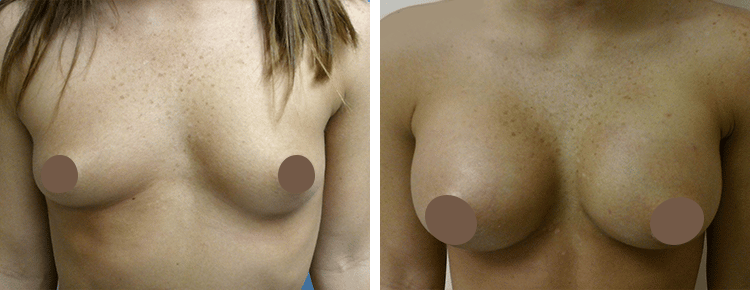 Saline Breast Augmentation Patient 2