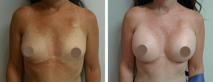 Saline Breast Augmentation Patient 3