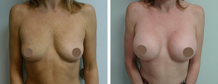 Saline Breast Augmentation Patient 4