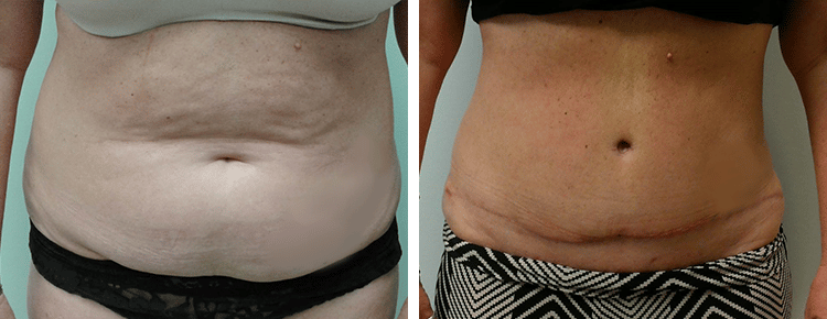 Tummy Tuck Patient 17