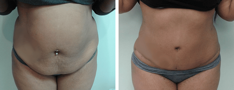 Tummy Tuck Patient 31