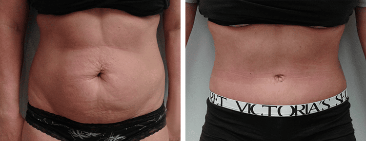 tummy tuck recovery week by week 2021 tummy tuck recovery week by week 2021