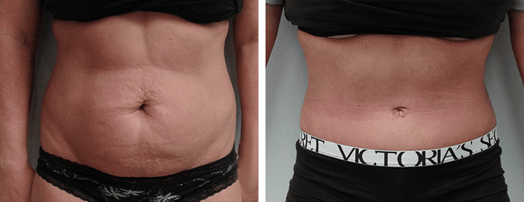 Tummy Tuck Patient 43