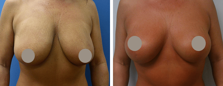 Breast Lift Patient 1