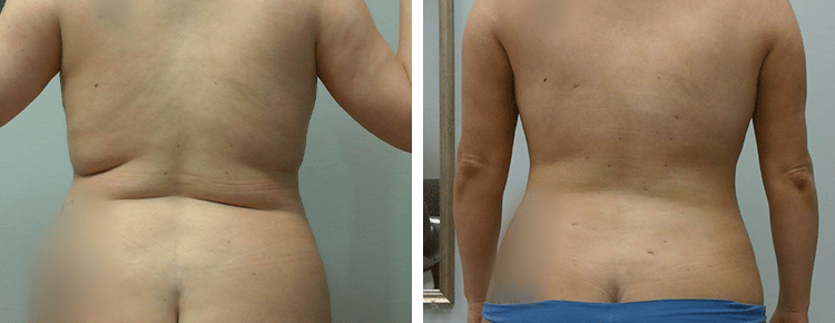 Liposuction for Men Before & After Photos Patient 149